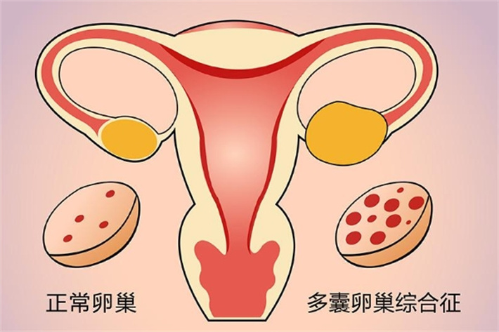多囊卵巢综合症6.jpg