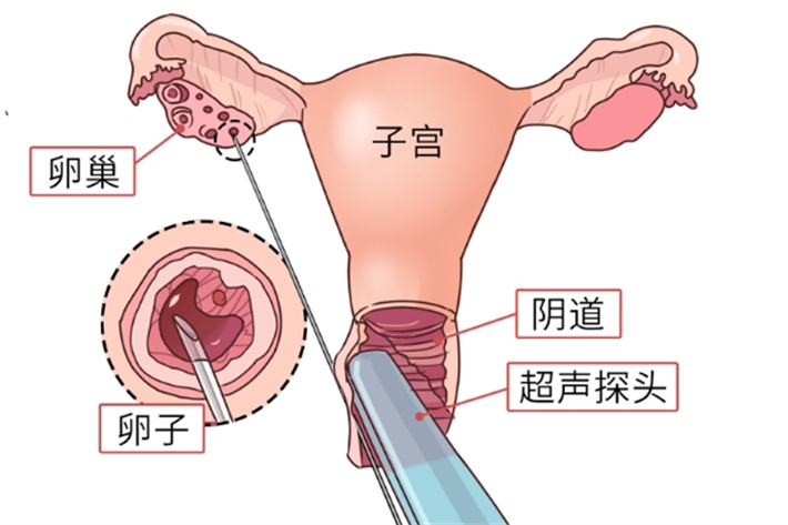 取卵