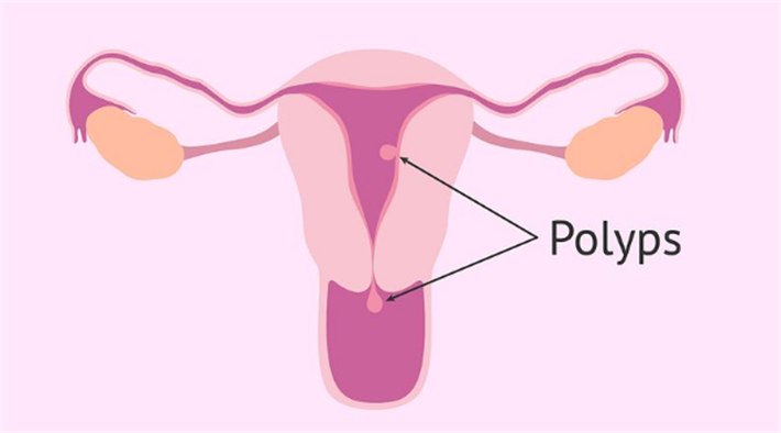 子宫内膜息肉