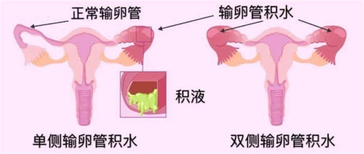 输卵管积液