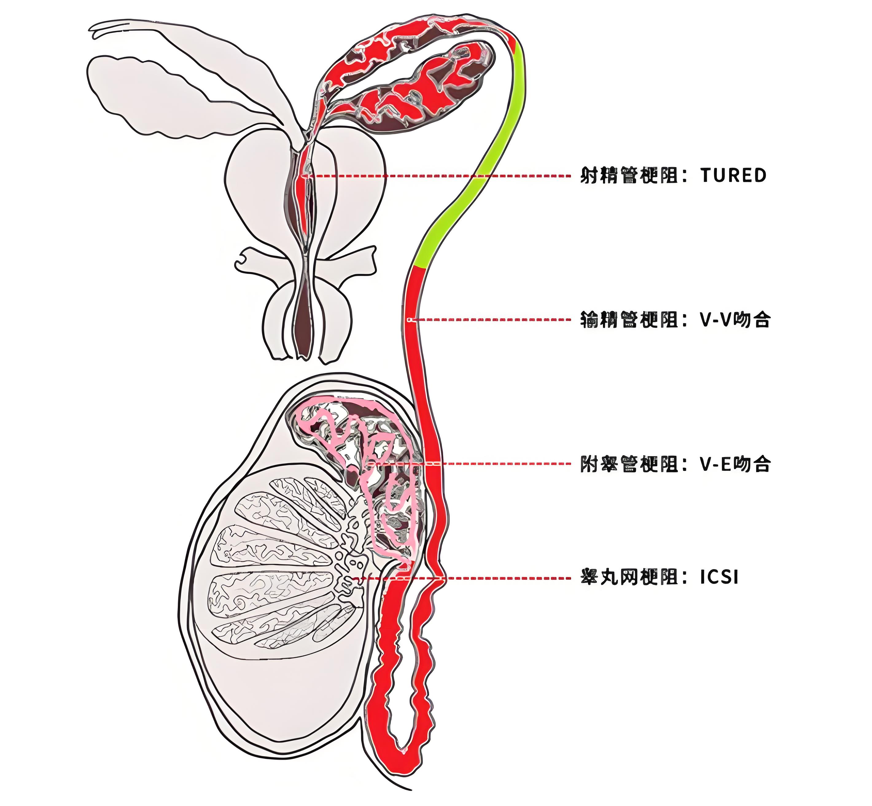 输精管堵塞