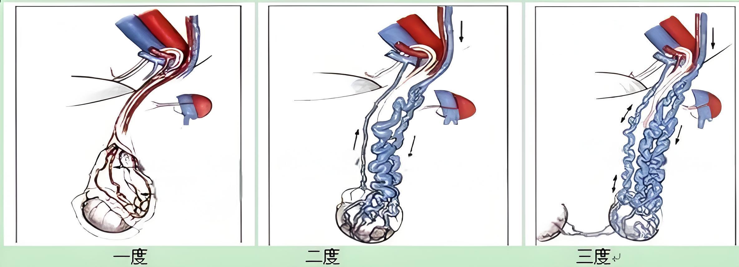 精索静脉曲张