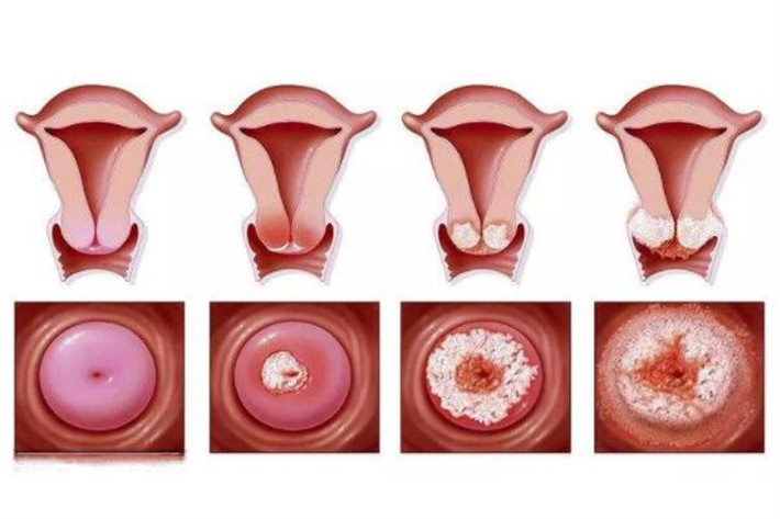 宫颈因素