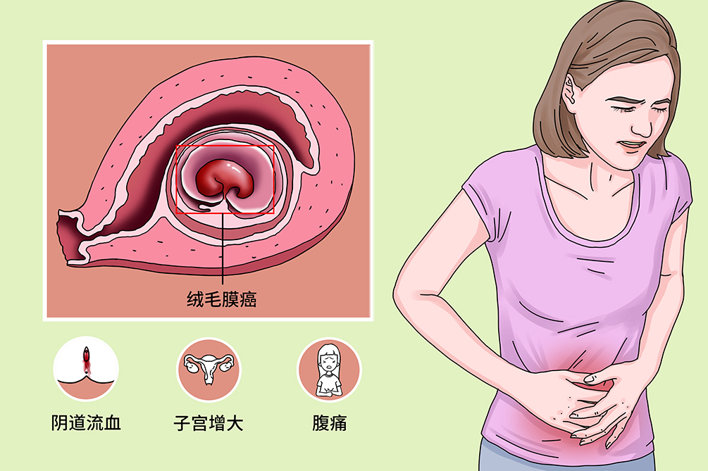 绒毛膜癌