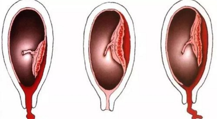 胎盘早剥风险增加
