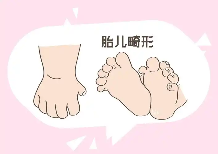 胎儿畸形