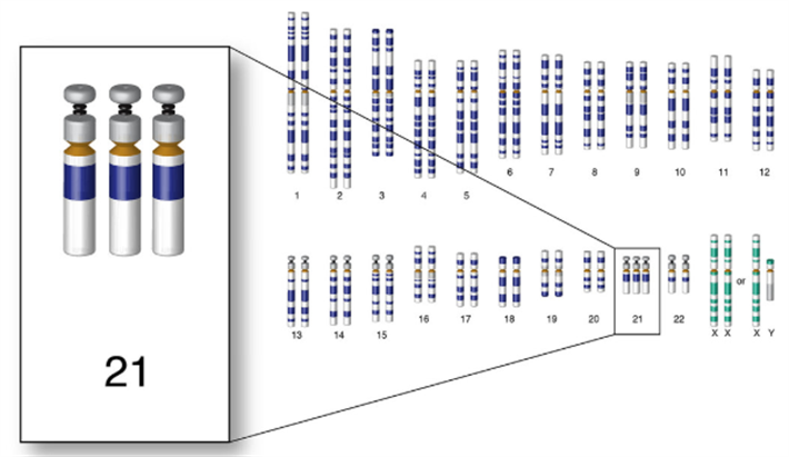 21 - 三体综合征（唐氏综合征）