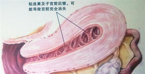 宫腔分离